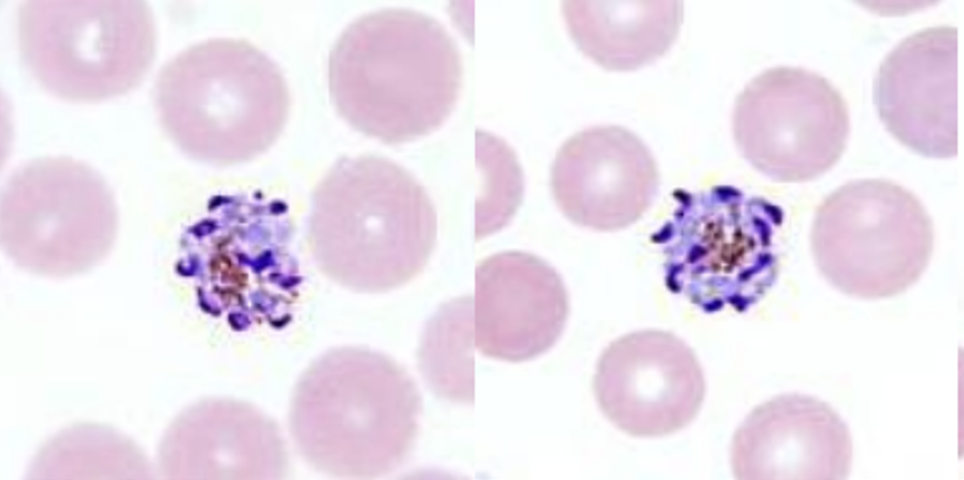 <p>Name: Plasmodium malariae</p><p class="p1">Stage: schizont</p><p class="p1">*cluster arrangment (abt 8 nuclei)(daisy head)</p>