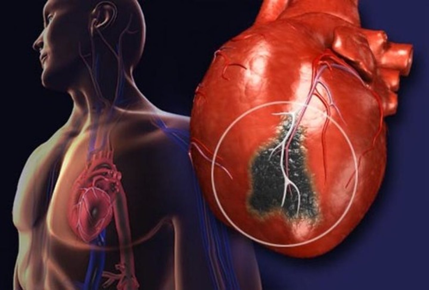 <p>heart attack</p>