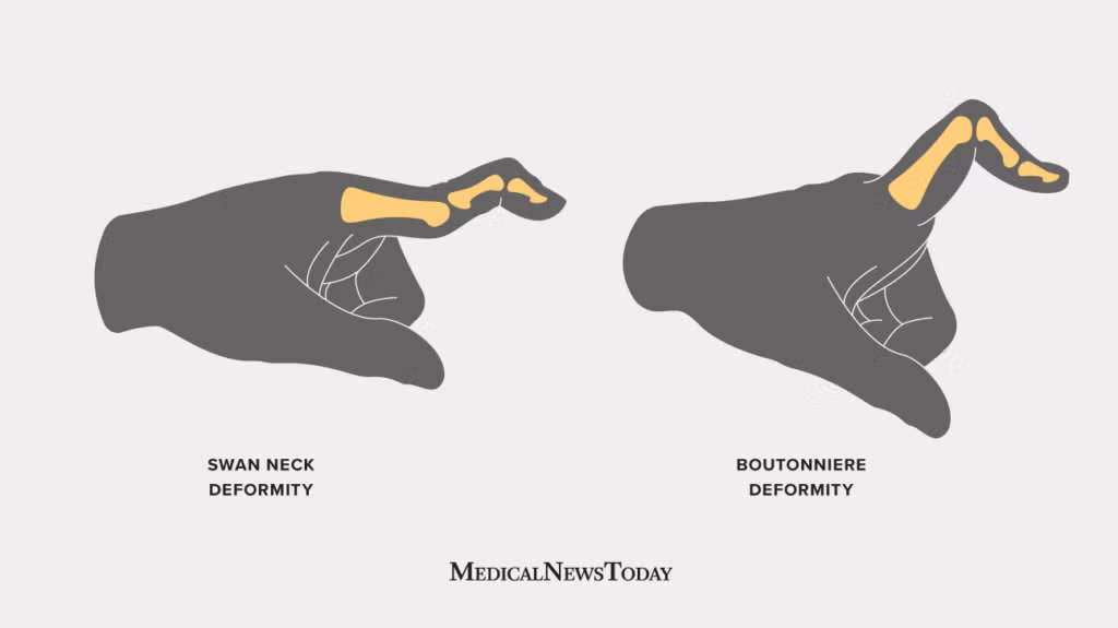 <p>swan neck is affected at the base joint (DIP hyperflexed, PIP hyperextendedd) rather than the middle joint (the PIP flexed due to torn extensor), bends inward.</p>