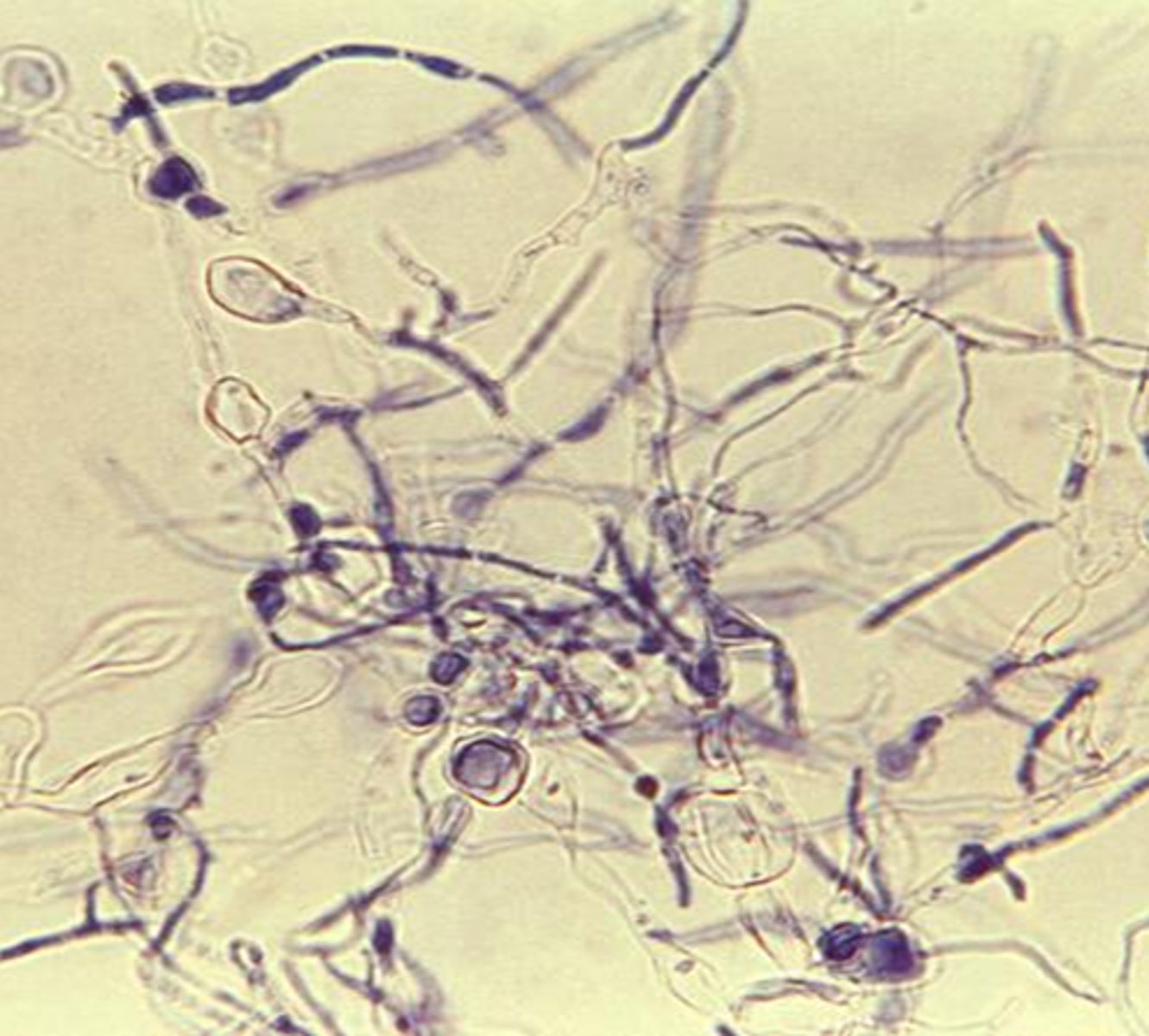 <p>Colony: glabrous, red violet brown or cream</p><p>Reverse: same, diffuses</p><p>Microconidia: usually absent</p><p>Macroconidia: typically absent</p><p>Hyphae: septate, irregular width</p><p>--may form chlamydospores</p><p>Disease: tinea capitis (#1 in Africa, Asia)</p><p>--skin, nails</p>