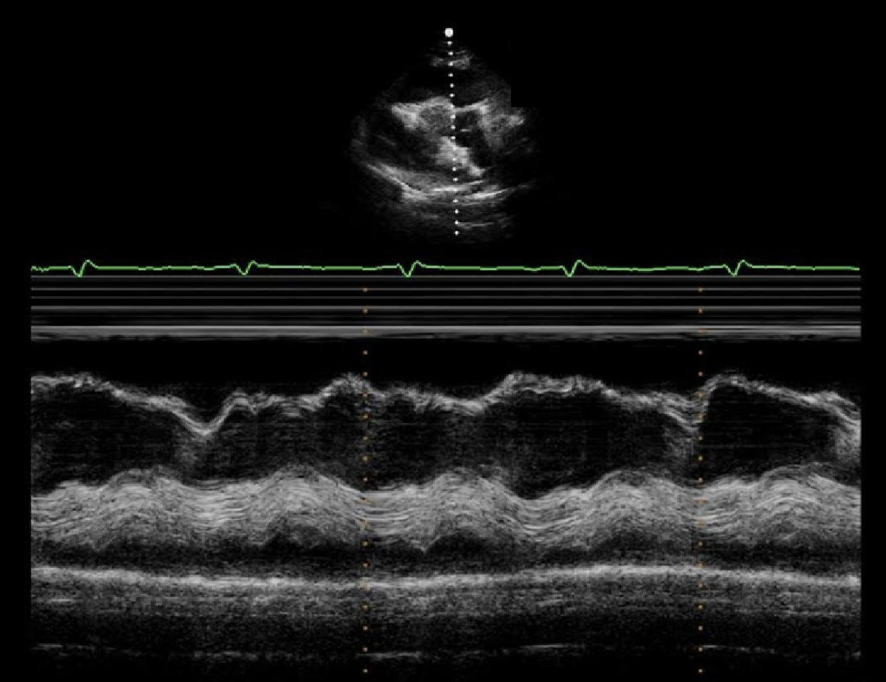 <p>The m-mode tracing is consistent with which of the following cardiac abnormalities? </p>