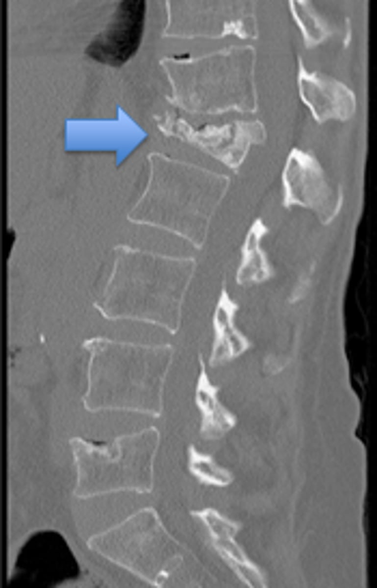<p>What is it?</p><p>- when there is loss of trabecular (spongy) and cortical bone mass as well as loss of interconnections despite normal bone mineralization and lab values (serum Ca2+ and PO4^3-)</p><p>What is it commonly caused by?</p><p>- increased bone reabsorption related to decreased estrogen levels and old age</p><p>- can also be secondary to drugs (ie: steroids, alcohol, anticonvulsants, anticoagulants, thyroid replacement therapy) or other medical conditions (ie: hyperparathyroidism, hyperthyroidism, MM, malabsorption syndromes)</p><p>How is it diagnosed?</p><p>- DEXA scan with T-score of < -2.5 or by a fragility fracture of the hip or vertebra</p><p>Ppx?</p><p>- regular weight bearing exercise and adequate Ca2+ and vitamin D intake throughout childhood</p><p>Treatment?</p><p>- bisphosphonates</p><p>- teriparatide</p><p>- SERMs</p><p>- rarely calcitonin</p><p>- denosumab (monoclonal antibody against RANKL)</p><p>What kinds of fractures can osteoporosis present with?</p><p>- vertebral compression fractures (acute back pain, loss of height, kyphosis)</p><p>- can also present with fractures of the femoral neck, distal radius (Colles fracture) --> note that femoral neck fractures lead to increased risk of osteonecrosis of the femoral head. the blood supply to the femoral head is mainly from the branches of the medial circumflex artery --> these vessels are especially vulnerable to damag from fractures of the head</p>