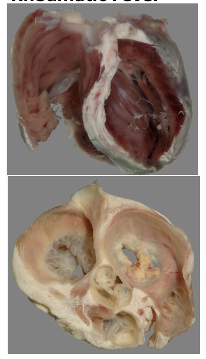 <p>Describe the appearance of these specimens (Rheumatic fever) - Are there any areas of obvious or specific abnormality?</p>