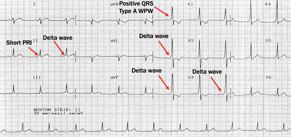 <p>short PR, wide QRS, delta wave</p>