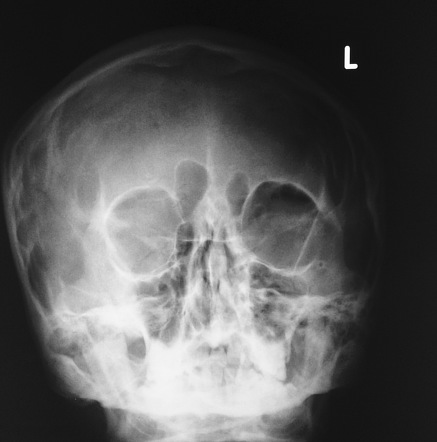 <p>Orbital blow-out fracture</p><p>CT is imaging of choice → may show black eyebrow sign </p>