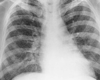 <p>fine discreet nodules throughout both lungs<br><br>(symmetric and spread through the blood in this PT)</p>