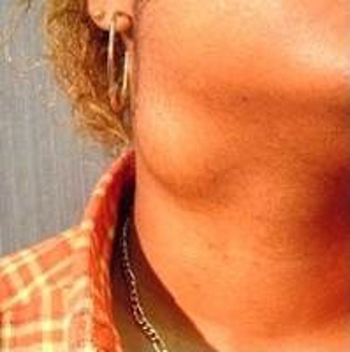 <p>Brachial cleft cyst</p>