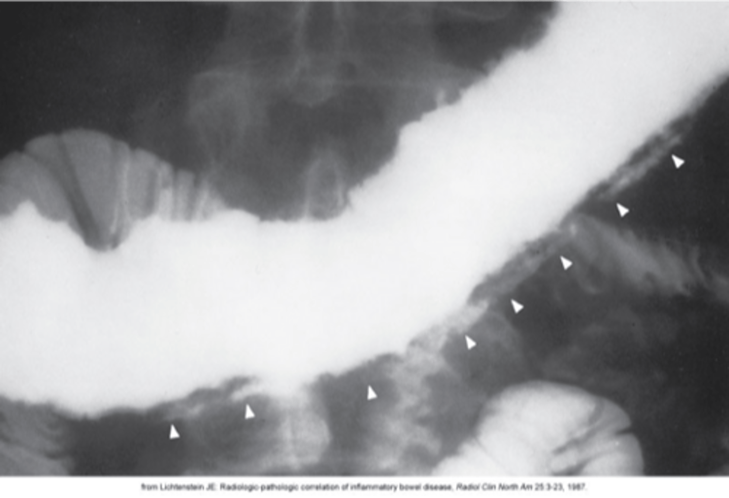 <p>What is Crohn's Colitis?</p>