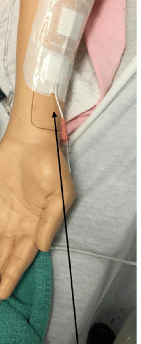 <p>placed in artery (radial, dorsal pedal, axillary, brachial, femoral)</p><p>-measures blood pressure, can draw blood</p>