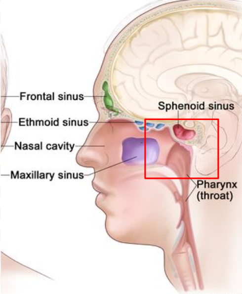 <p>Superior: 2 cm beyond tumor- to include Base of Skull + Sphenoid sinuses</p><p>Inferior: thyroid notch- to spare larynx</p><p>Anterior: include posterior 1/3 of maxillary sinus + nasal cavity.  More anterior tumors need 2cm margin.</p><p>Posterior: 2 cm margin beyond mastoid process OR posterior margin may extend further 1.5 cm margin on enlarged nodes </p><p></p>