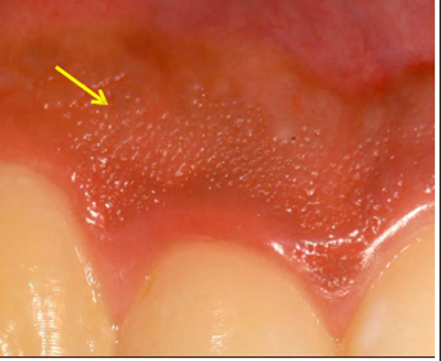 <p>Rete ridges - it increased surface area to anchor the oral epithelium to the deeper connective tissues</p><p>-locking the layers together allowing tissue to withstand more mechanical force</p>