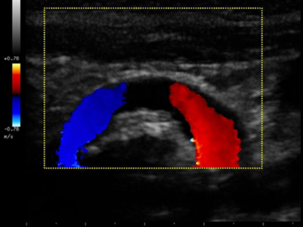 <p>Which of the following statements best describes the reason why there is an absence of color flow in the vessel on the image?</p><p>a. The ultrasound beam is parallel to the motion of the blood so non flow is detected<br>b. the color Doppler gain is set too low to detect the slower flow at the curve in the vessel <br>c. there is an occlusion present. flow is demonstrated proximal to the lesion with collateral flow filling the distal portion of the vessel<br>d. the ultrasound beam is perpendicular to the motion of blood so no flow is detected</p>