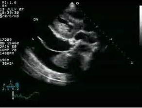 <p>What diagnosis can&nbsp;be made from this echo image?</p><p></p><p>Normal parasternal long axis</p><p>&nbsp;</p><p>Pericardial effusion</p><p>&nbsp;</p><p>Pericardial and pleural effusion</p><p>&nbsp;</p><p>Pleural effusion</p>