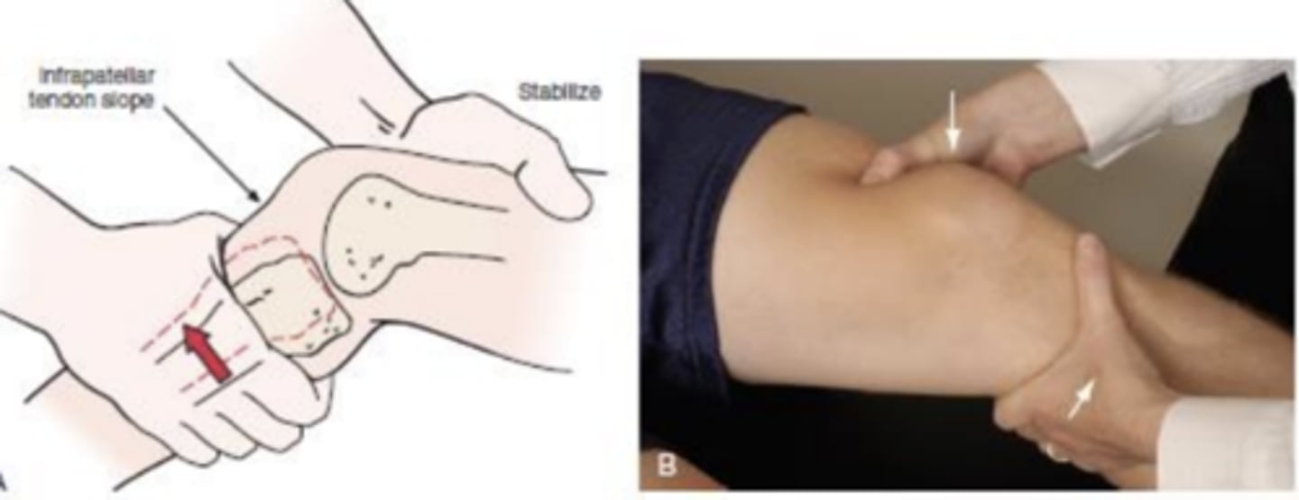 <p>- ACL</p><p>(+): mushy or soft end feel when tibia is moved forward on femur (increased anterior translation with medial rotation of the tibia) and disappearance of the infrapatellar tendon slope</p>