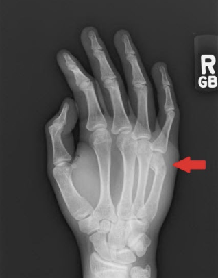 <p>What is this fracture?</p>