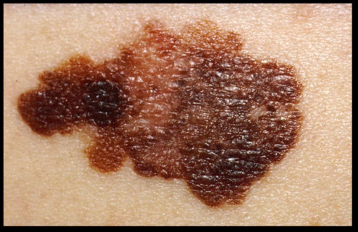 <p>Malignant growth or tumor caused by abnormal and uncontrolled cell division.</p>
