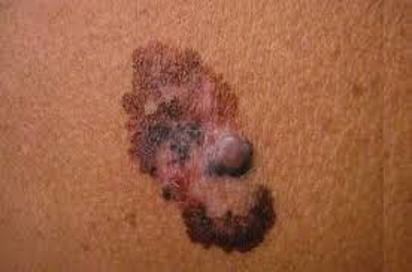<p>Welk klinisch letsel is dit?</p>