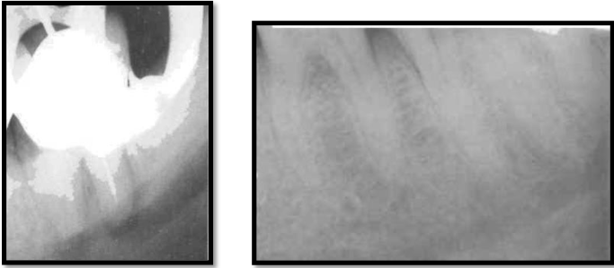 <p><strong><span>aka: </span></strong><span>inferior dental canal</span></p><p><span>runs from the </span><span style="color: red;"><span>mandibular foramen in the ramus to the mental foramen</span></span></p><p><span>seen as a radiolucent band and may lie in close association with the </span><span style="color: red;"><span>apices of molar and 2nd premolar teeth</span></span></p><p><span>extrusion of medicaments and root canal filling materials may damage the inferior dental bundle</span></p>