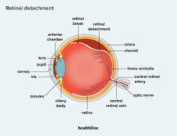 <p>Aging or an eye injury causes the retina to begin separating from the sclera which contains the blood vessels that provide necessary oxygen and nutrients.</p>