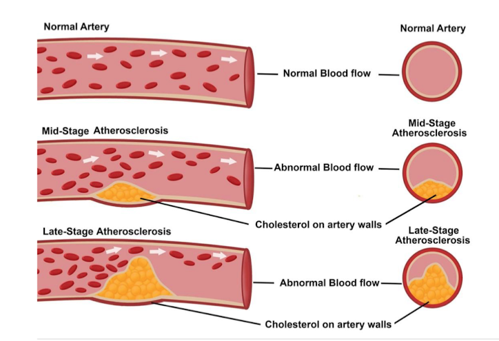 <p>blockage in the blod vessels due to increased plasma LDL, which leads to plaque, results in decreased blood flow. </p><p></p><p><strong>treatment </strong></p><ul><li><p>block de nova synthesis of cholesterol. T.ex inhibitors that blocks the production of mevalonate in stage 1 of production of cholesterol. </p></li><li><p>better diet. </p></li></ul><p></p>