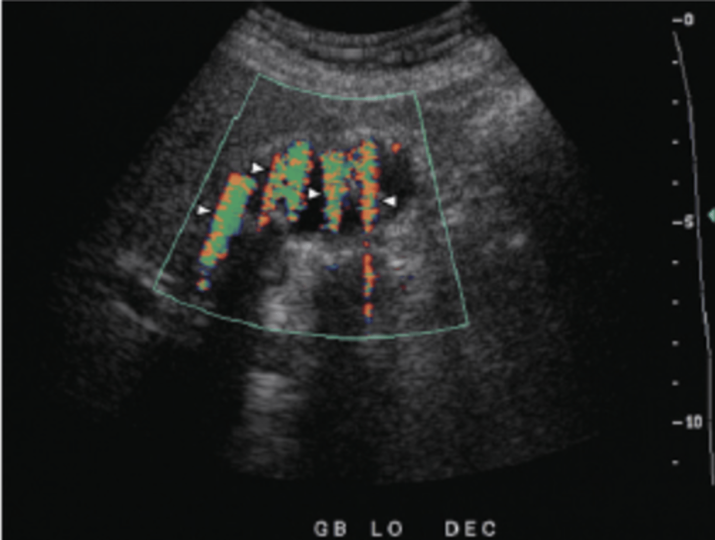 <p>Color motion/flow imitated behind a stationary strong reflector - stones, calcifications, etc.</p><p>Artifact looks like a stream of changing colors below reflector</p><p>Good for identifying certain pathologies - GB/renal stones</p>