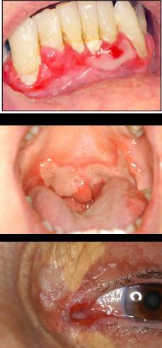 <p></p><p><span style="color: blue;"><strong><em><u>AUTOIMMUNE</u></em></strong></span></p><p>Pemphigoid</p><ul><li><p>Clinical Signs</p></li><li><p>Etiology</p></li><li><p>Treatment</p></li></ul><p></p>