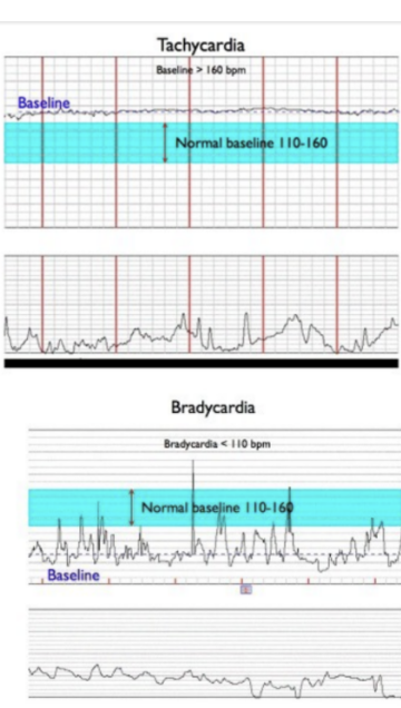 <p>how well is CNS functioning?</p><ul><li><p>fluctuations in FHR around the baseline</p></li><li><p>exclude accels/decels</p></li><li><p>between UCs</p></li><li><p>NOT ASSESSED DURING AN “EVENT”</p></li></ul>