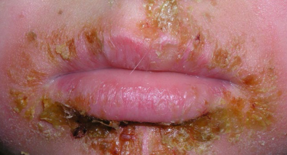 <p>what type of lesion is depicted</p>