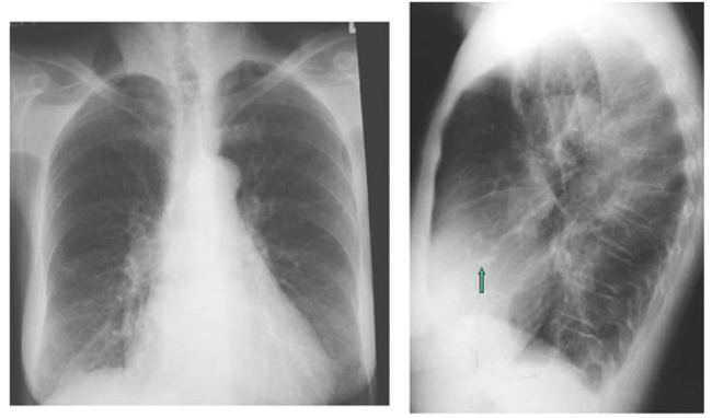 <p>Determine presence of pulmonary edema</p><p>Calcifications in aortic valve = More severe</p><p>LV hypertrophy</p>
