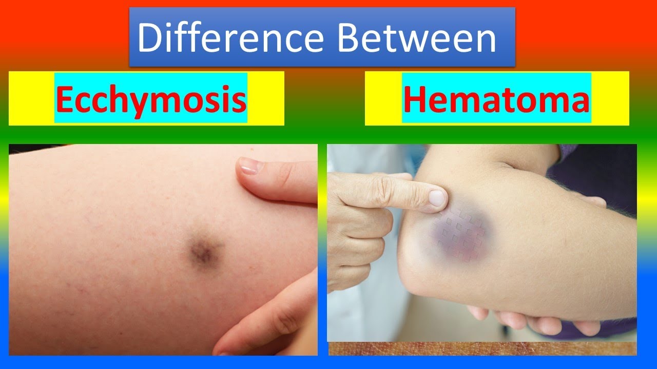 <p>solid swelling of clotted blood (usually bulbous while a bruise is usually flat and is generally larger than a bruise))</p>