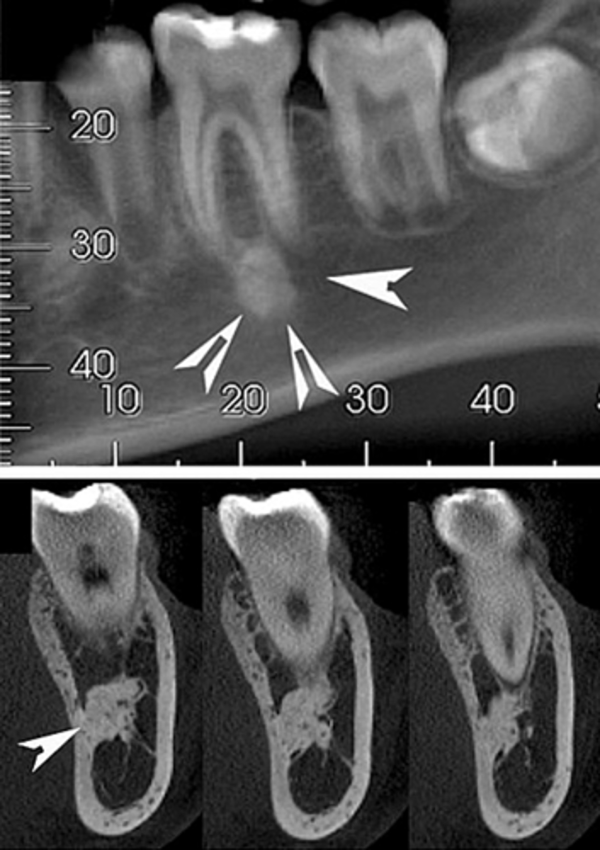 <p>Idiopathic osteosclerosis</p>