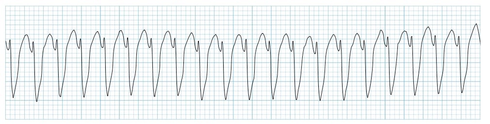 <p>Ventricular Tachycardia</p><p></p><p>Treated by lidocaine, defibrillation, CPR, procainamide, amiodarone</p><ul><li><p>Cardiovert if awake, defib if not</p></li></ul><p></p>