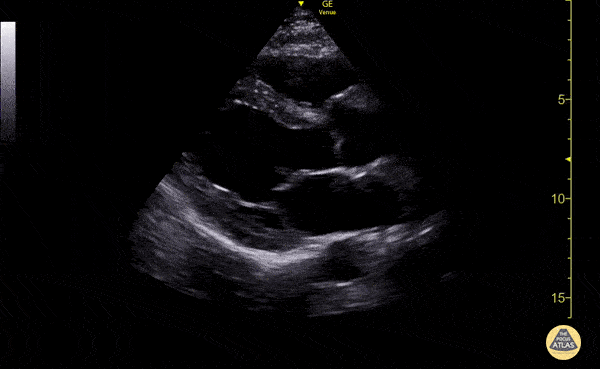 Where there is about a thumb size of myocardium from the bottom of the screen to the back of the heart.