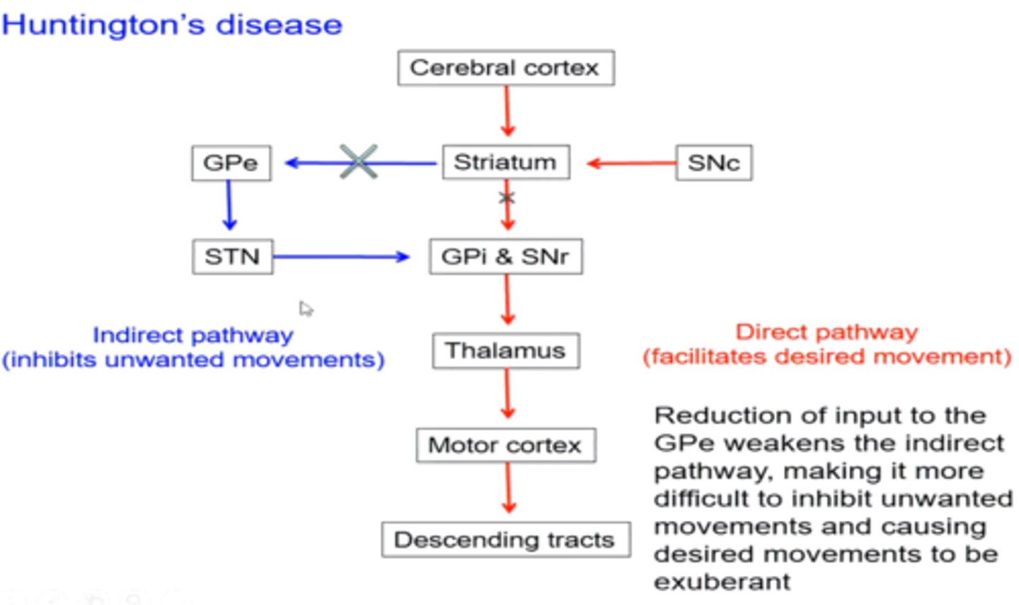 <p>loss of striatal (mainly caudate) neurons of the indirect pathway, letting unwanted movements occur</p>