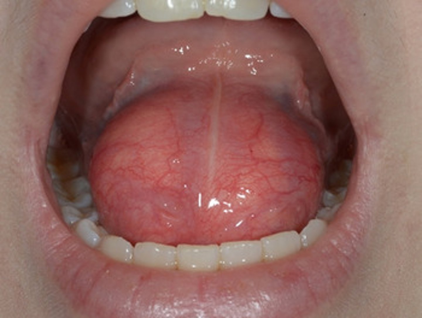 <p>A midline floor of mouth swelling that elevates the tongue and has been presnt for years. It feels doughly, not fluid-filled.</p><p>What is the diagnosis?</p>