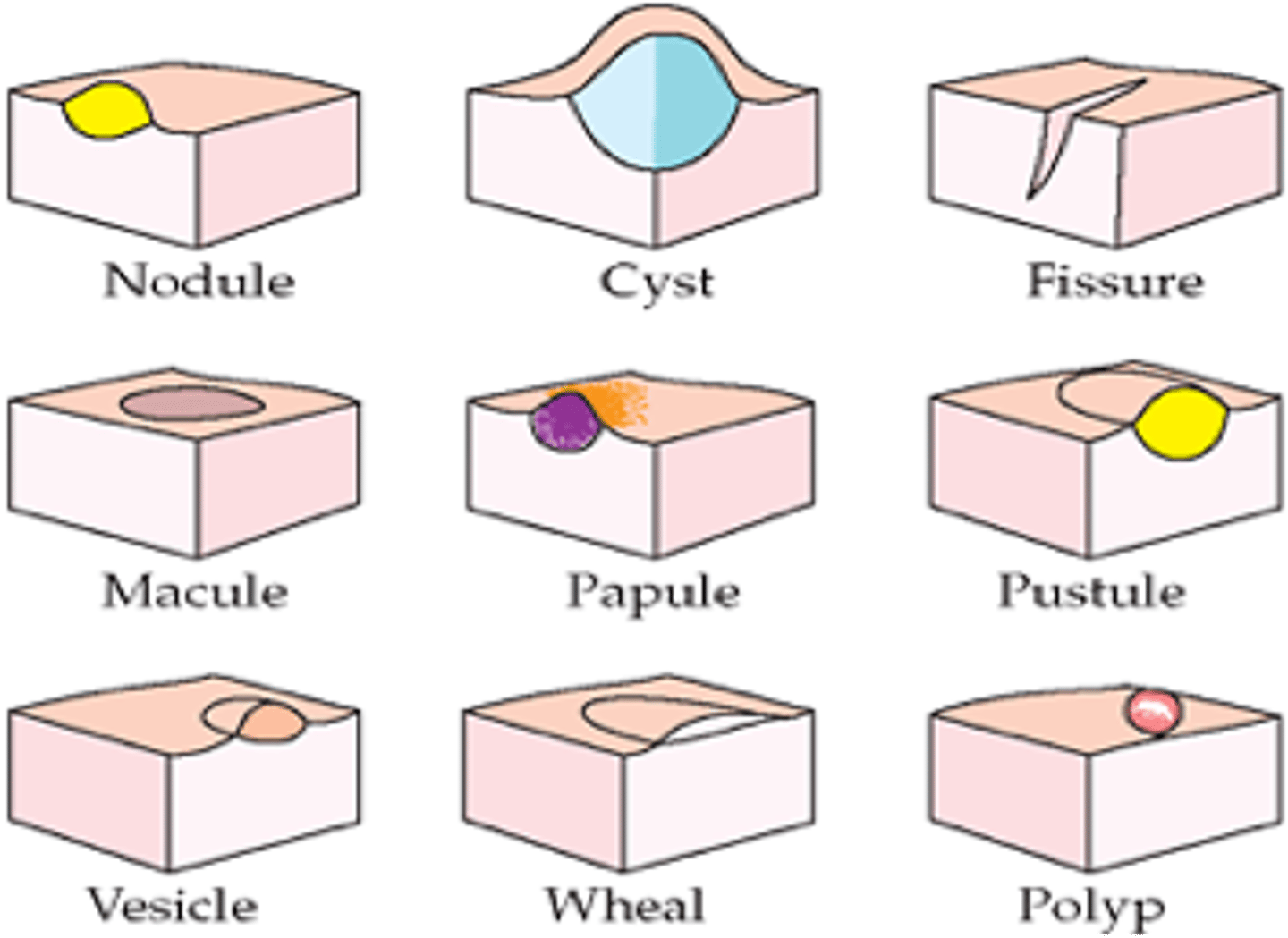 <p>1. Macules</p><p>2. Patches</p><p>3. Papules</p><p>4. Plaques</p><p>5. Nodules</p><p>6. Wheals</p><p>7. Vesicles</p><p>8. Bullae</p><p>9. Pustules</p>
