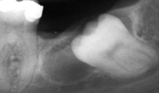 <p>Dentigerous cyst, you can see a lesion near the crown of the tooth but it has to be an impacted tooth to see a pericoronal lesion. </p>