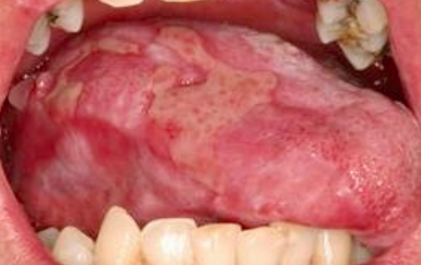<p>Lichenoid mucositis</p>