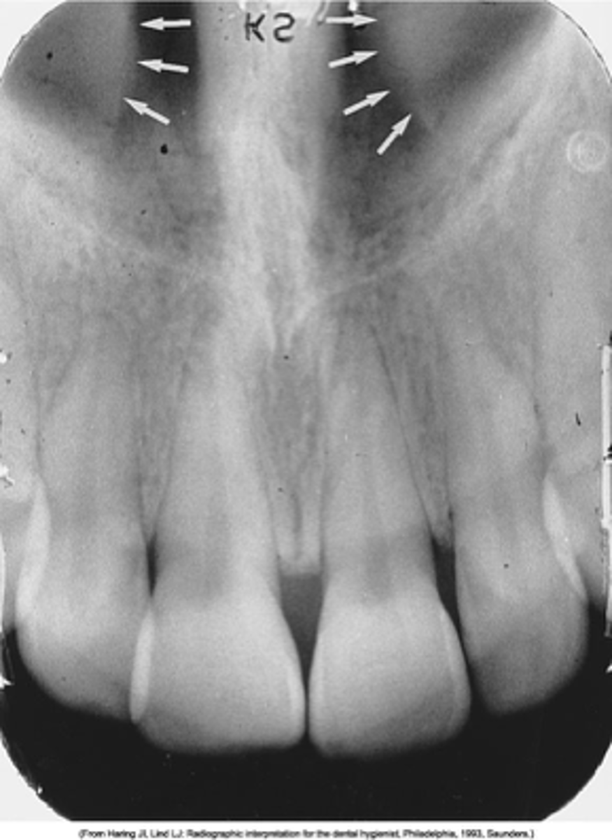<p>Radiopaque projection in the nasal cavity</p>