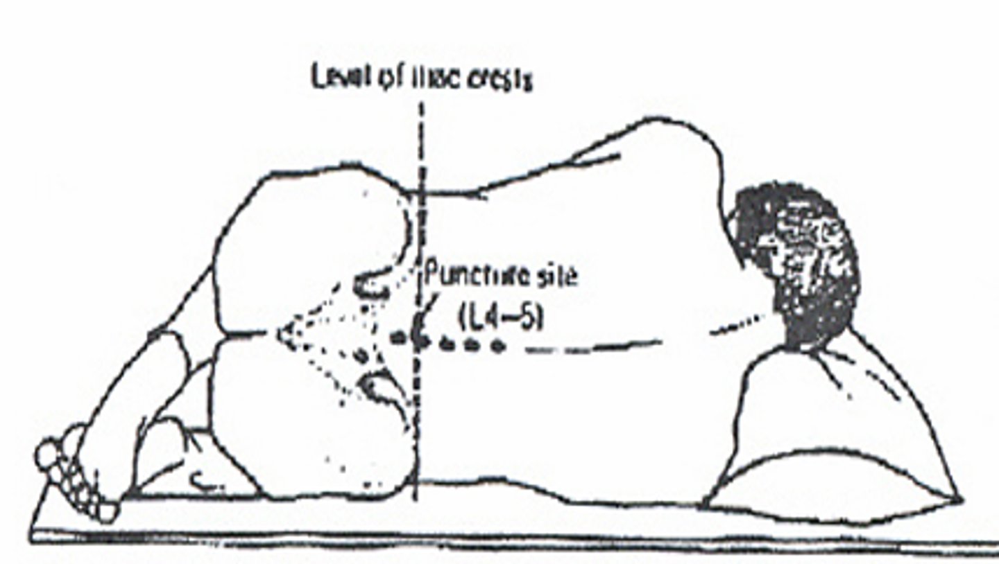 <p>o Horizontal line between posterior ileac crests localizes proper vertebral space</p><p>o Easiest to locate space when patient is maximally flexed</p><p>o May also be done when patient is sitting</p>