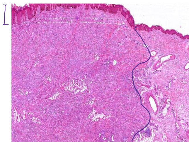 <p>a tumor consisting of <strong><span style="color: red">fibroblasts and histiocyte-like cells</span></strong>, typically found in the <strong><span style="color: red">skin of the lower extremities (95%)</span></strong></p><ul><li><p>also known as <strong><mark data-color="blue">dermatofibroma</mark></strong></p></li></ul>