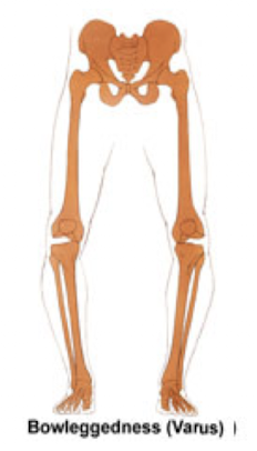 <p><strong>Varus</strong> = <strong>inward angulation of the distal segment</strong> of a bone or joint.<br>Example: <strong>Bowlegs</strong> (knees stay apart, ankles move medially).</p><p>Load direction: <strong>medial → lateral</strong>.</p><p>Memory hook: <strong>VaRUS = knees go “out”</strong></p>