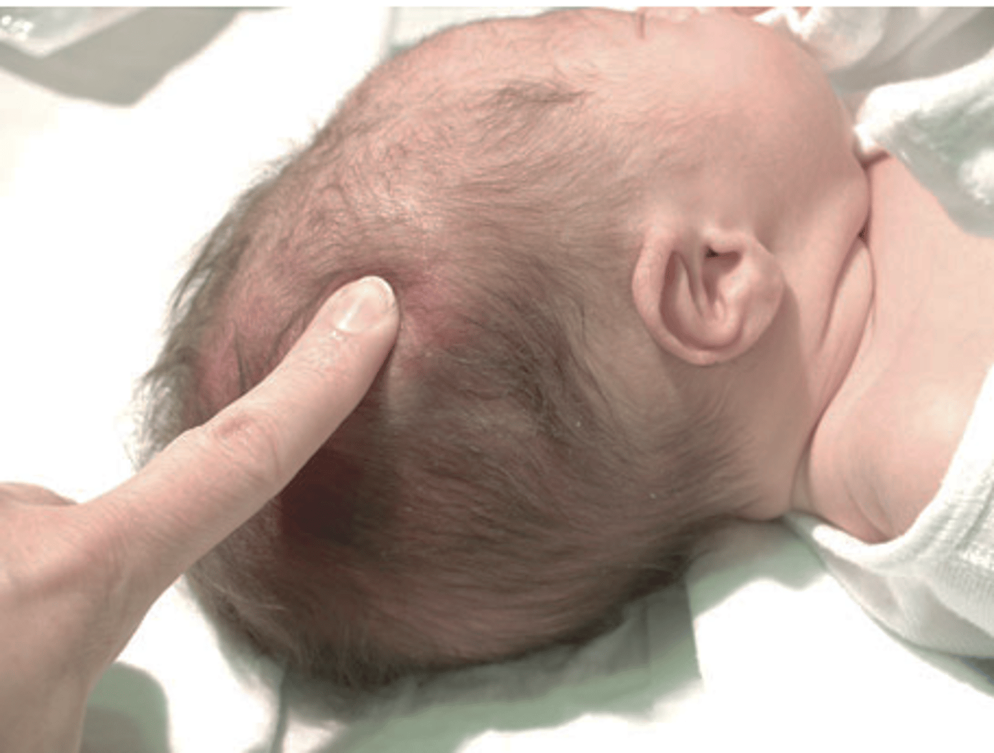 <p>- Superficial scalp edema</p><p>- crosses suture lines</p><p>- soft/boggy</p><p>- resolves on own</p>