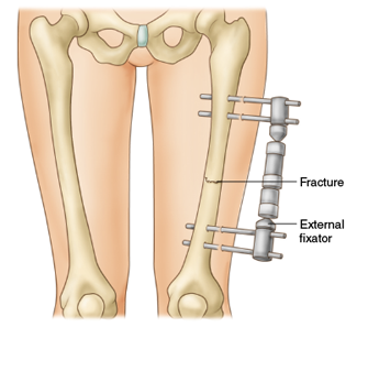 <p>is a fracture treatment procedure in which pins are placed through the soft tissues and bone so that an external appliance can be used to hold the pieces of bone firmly in place during healing. When healing is complete, the appliance is removed</p>