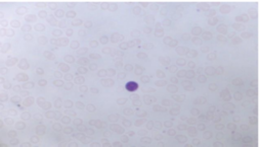 <ul><li><p>RBCs are microcytic (smaller than normal)</p></li><li><p>Hypochromic (lacking significant pigmentation)&nbsp;</p></li><li><p>Causes: secondary result of hemorrhagic anemia, inadequate intake of iron-containing foods, impaired iron absorption</p></li></ul><p></p>