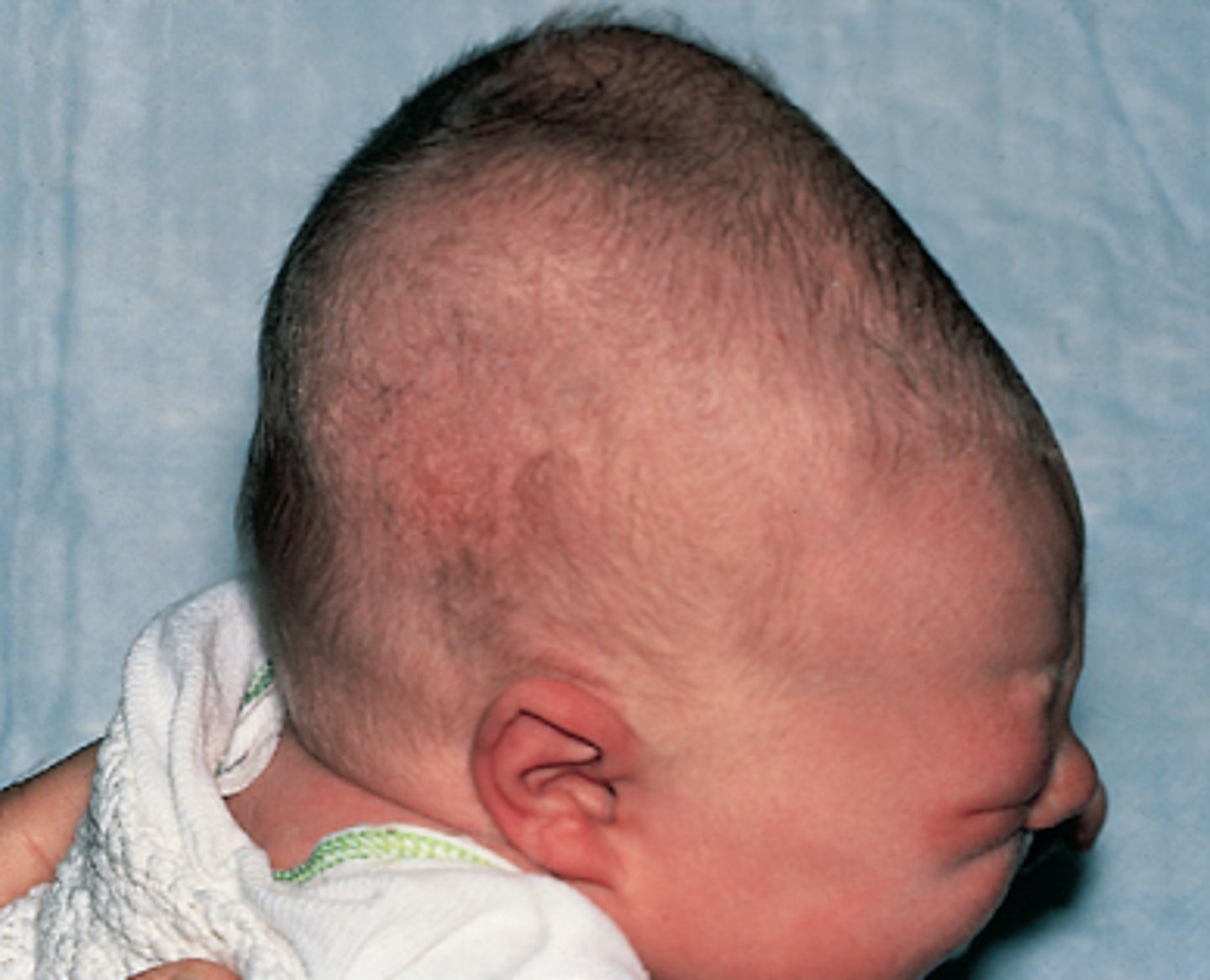 <p>occurs with normal vaginal deliveries causing misshapen or elongated scalp</p>