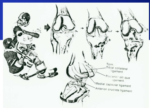 <ul><li><p>3 structures damaged</p><ul><li><p>MCL rupture: Valgus loading tibia rotates outward</p></li><li><p>Meniscus (lateral) tear: Compression of postero-lateral tibio-femoral compartment → valgus collapse, femoral plateau contusion</p></li><li><p>ACL rupture: tibial rotaion and anterior displacement on femur</p></li></ul></li></ul><p></p>