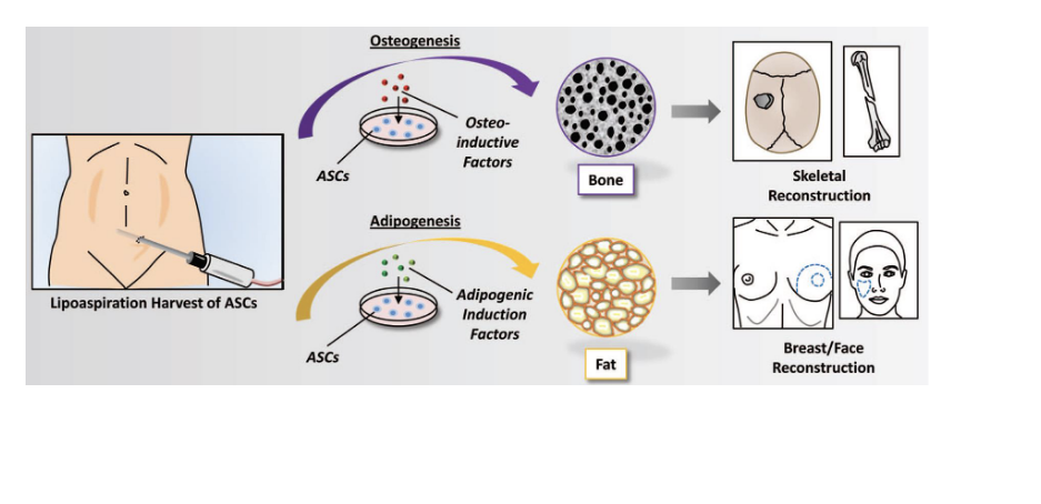 <p>regenerative medicine</p><ul><li><p>lipoaspiration to harvest ASCs</p></li><li><p>2 pathways</p><ul><li><p>osteogenesis (bone formation)</p><ul><li><p>ASCs are exposed to osteo-inductive factors → differentiate into bone cells → used for skeletal reconstruction</p></li></ul></li><li><p>adipogenesis (fat formation)</p><ul><li><p>ASCs are exposed to adipogenic induction factors → differentiate into fat cells → breast/face reconstruction</p><p></p></li></ul></li></ul></li></ul><p></p>
