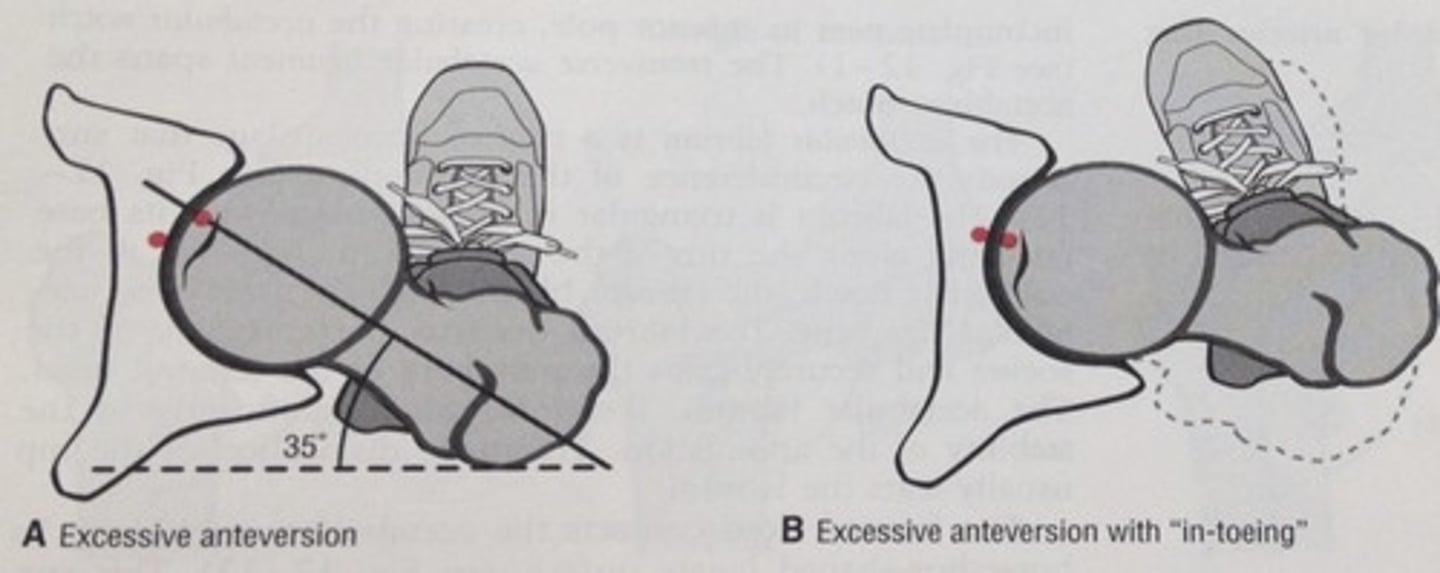 <p>moment arm of glut med = DECREASED</p><p>joint reaction forces = INCREASED</p><p>joint congruency = DECREASED</p>