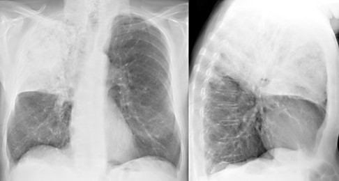<p>Lobar or baterial (pneumonia)</p>